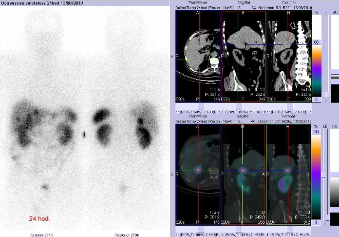Obr. č. 6: Celotělová scintigrafie a fúze obrazů SPECT a CT. Vyšetření 24 hod. po aplikaci radioindikátoru. Zaměřeno na ložisko v dorzomediální části pravého jaterního laloku.