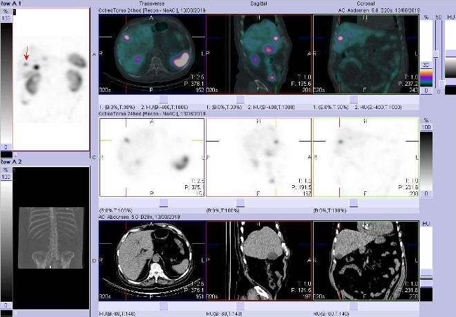Obr. č. 7: Fúze obrazů SPECT a CT – vyšetření 24 hod. po aplikaci radiofarmaka. Zaměřeno na ložisko ve ventrolaterální části pravého jaterního laloku.