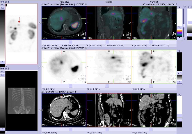Obr. č. 8: Fúze obrazů SPECT a CT – vyšetření břicha a pánve 24 hod. po aplikaci radiofarmaka. Zaměřeno na ložisko na rozhraní obou laloků.