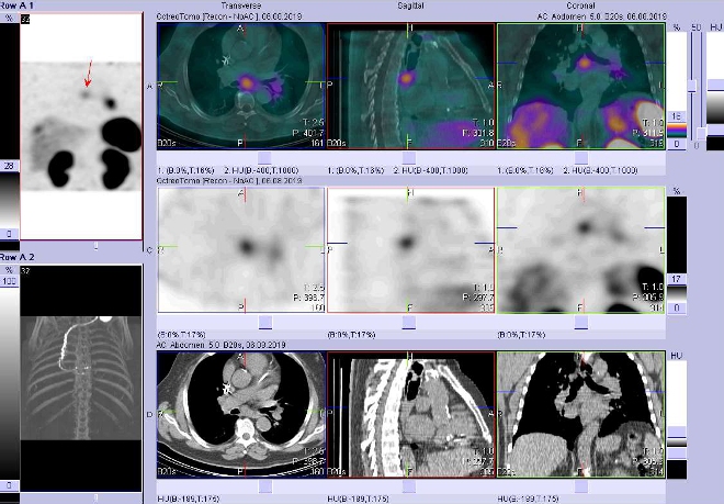 Obr.3: Fúze obrazů SPECT a CT – vyšetření 4 hod. po aplikaci radiofarmaka. Zaměřeno na uzlinu pod bifurkací trachey.