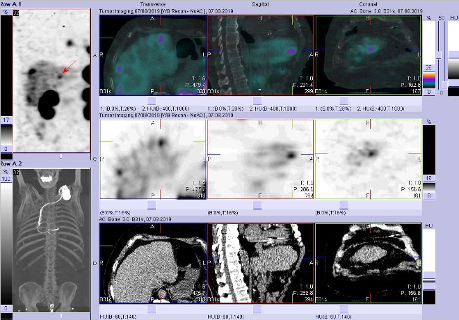 Obr. č. 5: Celotělová scintigrafie a fúze obrazů SPECT a CT. Vyšetření 24 hod. po aplikaci radioindikátoru. Zaměřeno na ložisko v levém jaterním laloku.