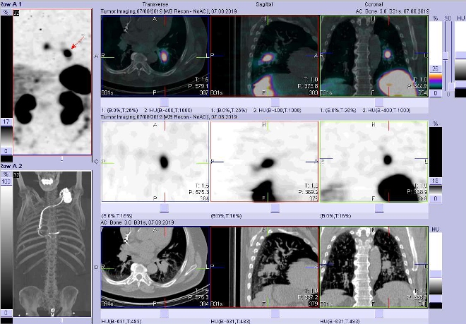 Obr. č. 6: Fúze obrazů SPECT a CT – vyšetření 24 hod. po aplikaci radiofarmaka. Zaměřeno na ložisko v levé plíci.
