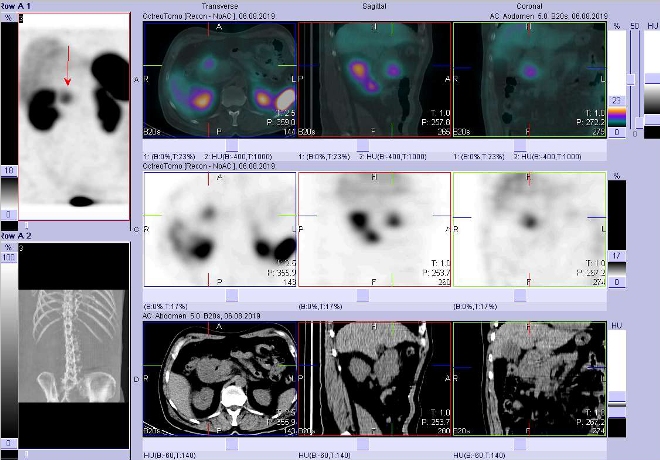 Obr. č. 2: Fúze obrazů SPECT a CT – vyšetření břicha a pánve 4 hod. po aplikaci radiofarmaka. Zaměřeno na ložisko v oblasti duodena.