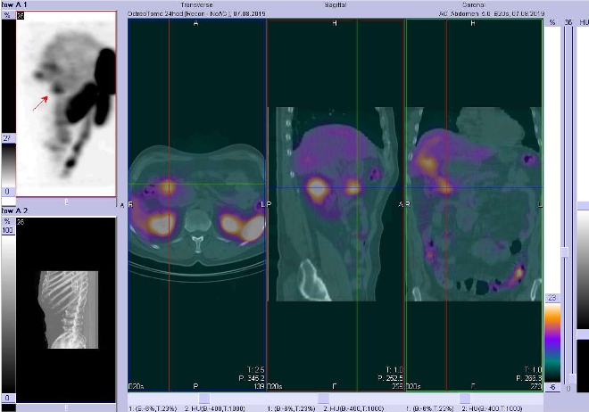 Obr. č. 3: Fúze obrazů SPECT a CT – vyšetření 24 hod. po aplikaci radiofarmaka. Zaměřeno na ložisko v oblasti duodena.