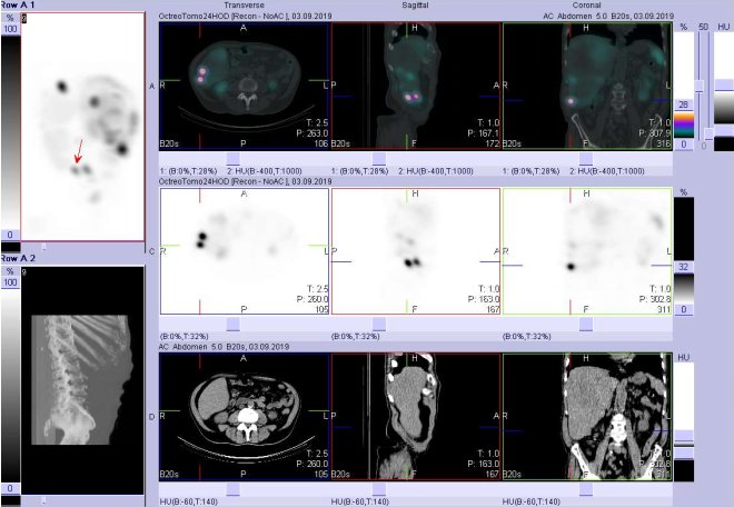 Obr. č. 13: Fúze obrazů SPECT a CT. Vyšetření 24 hod. po aplikaci radioindikátoru. Zaměřeno na dvě ložiska v pravém jaterním laloku.