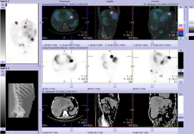 Obr. č. 14: Fúze obrazů SPECT a CT. Vyšetření 24 hod. po aplikaci radioindikátoru. Zaměřeno na ložisko v levém jaterním laloku.