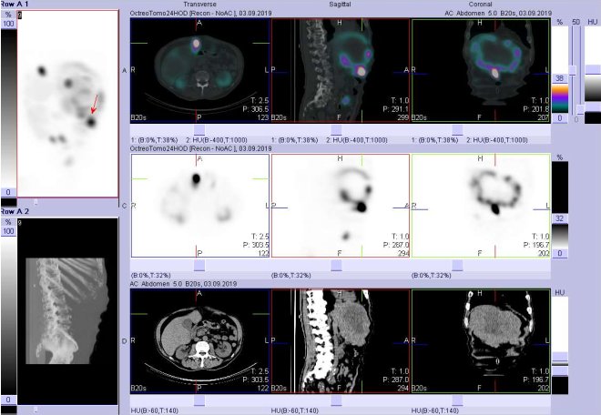 Obr. č. 15: Fúze obrazů SPECT a CT. Vyšetření 24 hod. po aplikaci radioindikátoru. Zaměřeno na ložisko v levém jaterním laloku.