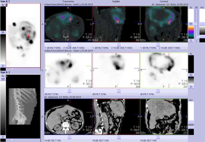 Obr. č. 17: Fúze obrazů SPECT a CT. Vyšetření 24 hod. po aplikaci radioindikátoru. Zaměřeno na ložisko v levém jaterním laloku.