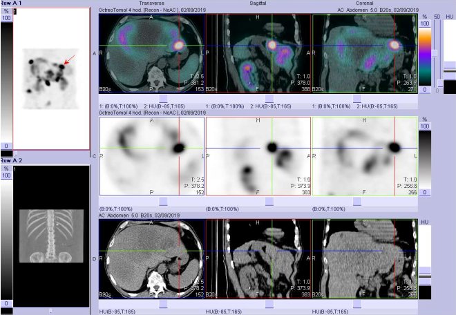 Obr. č. 4: Fúze obrazů SPECT a CT. Vyšetření 4 hod. po aplikaci radioindikátoru. Zaměřeno na ložisko v levém jaterním laloku.