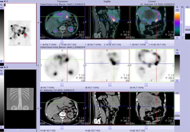 Obr. č. 7: Fúze obrazů SPECT a CT. Vyšetření 4 hod. po aplikaci radioindikátoru. Zaměřeno na ložisko v levém jaterním laloku.