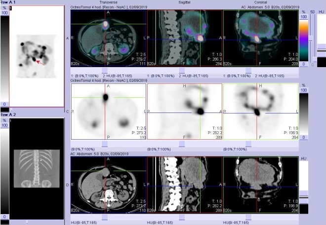 Obr. č. 8: Fúze obrazů SPECT a CT. Vyšetření 4 hod. po aplikaci radioindikátoru. Zaměřeno na ložisko v levém jaterním laloku.