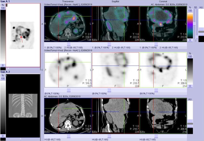 Obr. č. 9: Fúze obrazů SPECT a CT. Vyšetření 4 hod. po aplikaci radioindikátoru. Zaměřeno na ložisko v pravém jaterním laloku.