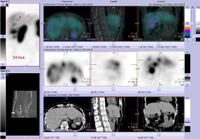 Obr. č. 10: Fúze SPECT/CT 24 hod. po aplikaci OctreoScanu. Zaměřeno na ložisko v játrech ventrálně v pravém laloku v blízkosti pomezí pravého a levého laloku.