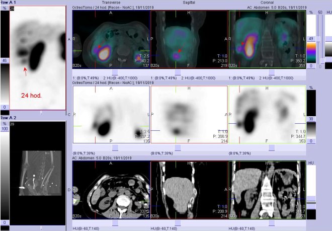 Obr. č. 12: Fúze obrazů SPECT a CT. Vyšetření 24 hod. po aplikaci radioindikátoru. Zaměřeno na ložisko v pravém jaterním laloku.