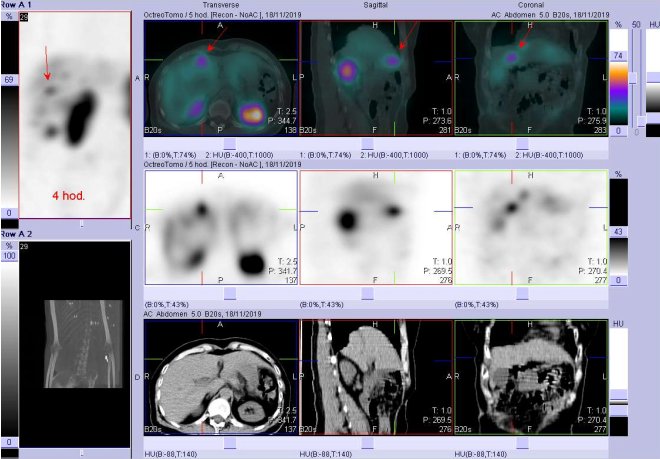 Obr. č. 5: Fúze SPECT/CT 4 hod. po aplikaci OctreoScanu. Zaměřeno na ložisko ve ventrální části pravého jaterního laloku.