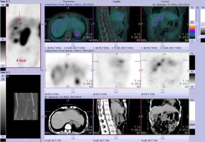 Obr. č. 6: Fúze SPECT/CT 4 hod. po aplikaci OctreoScanu. Zaměřeno na ložisko v játrech ventrálně v pravém laloku v blízkosti pomezí pravého a levého laloku.