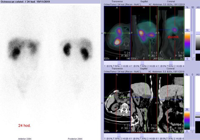 Obr. č. 9: Celotělová scintigrafie a fúze SPECT/CT 24 hod. po aplikaci OctreoScanu. Zaměřeno na žlučník. 