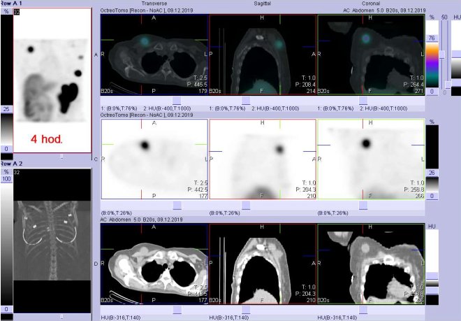 Obr.č.2: Fúze SPECT/CT 4 hod. po aplikaci OctreoScanu. Zaměřeno na podkožní ložisko vpravo v horní a ventrální části hrudníku.