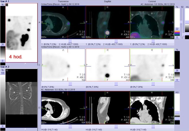 Obr.3: Fúze SPECT/CT 4 hod. po aplikaci OctreoScanu. Zaměřeno na podkožní ložisko vlevo v laterální části hrudníku.