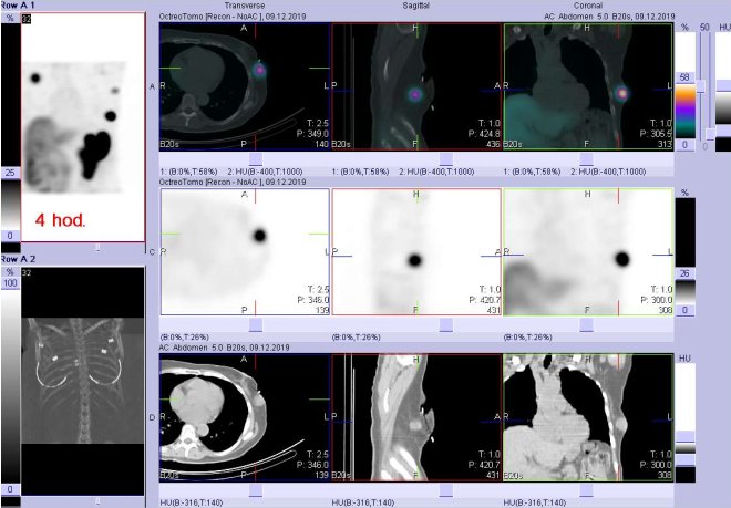 Obr. č. 4: Fúze SPECT/CT 4 hod. po aplikaci OctreoScanu. Zaměřeno na další podkožní ložisko vlevo v laterální části hrudníku.