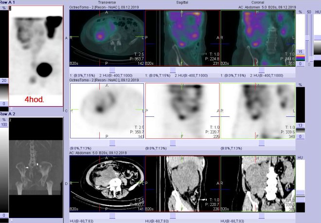 Obr. č. 7: Fúze SPECT/CT 4 hod. po aplikaci OctreoScanu. Zaměřeno na dolní část obrovského ložiska v pravé části břicha.