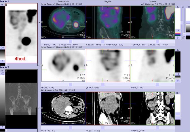Obr. č. 8: Fúze SPECT/CT 4 hod. po aplikaci OctreoScanu. Zaměřeno na laterální část obrovského ložiska v pravé části břicha.