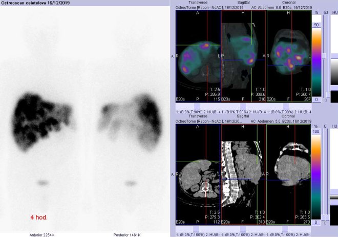 Obr.č.2: Celotělová scintigrafie v přední a zadní projekci a fúze SPECT/CT se zaměřením na jaterní ložisko 4 hod. po aplikaci OctreoScanu.