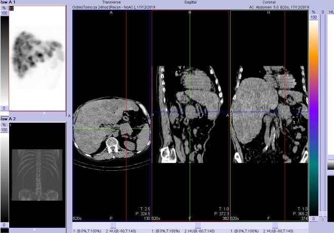 Obr.3: CT 24 hod. po aplikaci OctreoScanu. Zaměřeno na ložisko v kaudě pankreatu.
