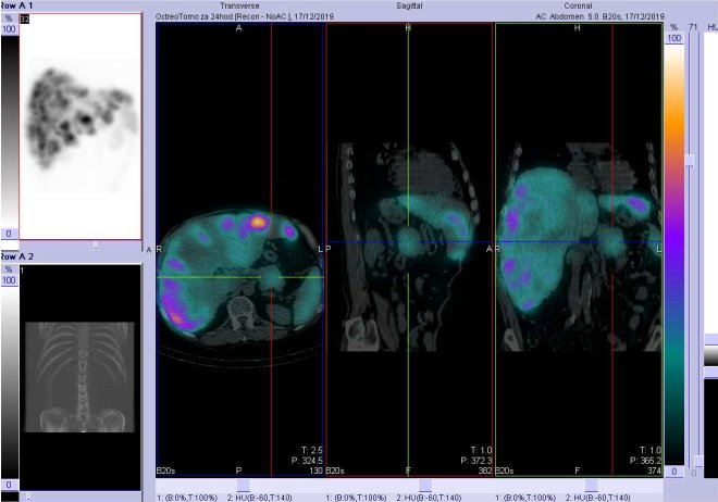 Obr. č. 4: Fúze SPECT/CT 24 hod. po aplikaci OctreoScanu. Zaměřeno na ložisko v kaudě pankreatu.