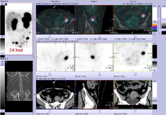 Obr. č. 10: Fúze SPECT/CT břicha 24 hod. po aplikaci OctreoScanu. Zaměřeno na ložisko v pánvi vlevo laterálně.