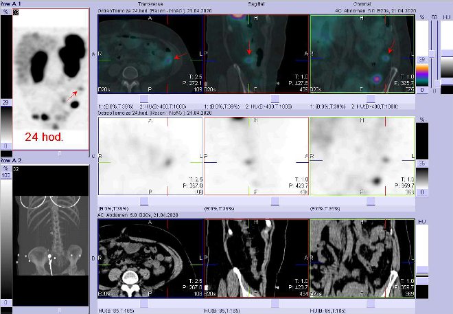 Obr. č. 11: Fúze SPECT/CT břicha a pánve 24 hod. po aplikaci OctreoScanu. Zaměřeno na ložisko v břiše vlevo nad pánví.