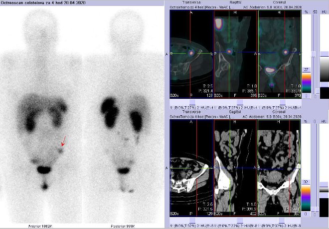 Obr.č.2: Celotělová scintigrafie a fúze SPECT/CT břicha 4 hod. po aplikaci OctreoScanu. Zaměřeno na ložisko v pánvi vlevo laterálně.