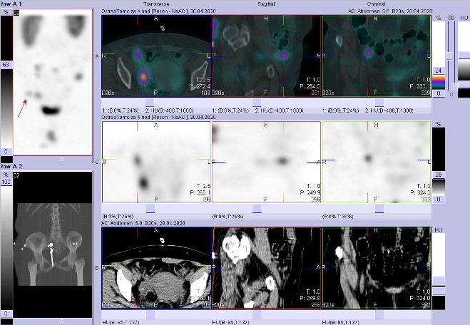 Obr.3: Fúze SPECT/CT břicha a pánve 4 hod. po aplikaci OctreoScanu. Zaměřeno na ložisko v pánvi vpravo ventrálně.