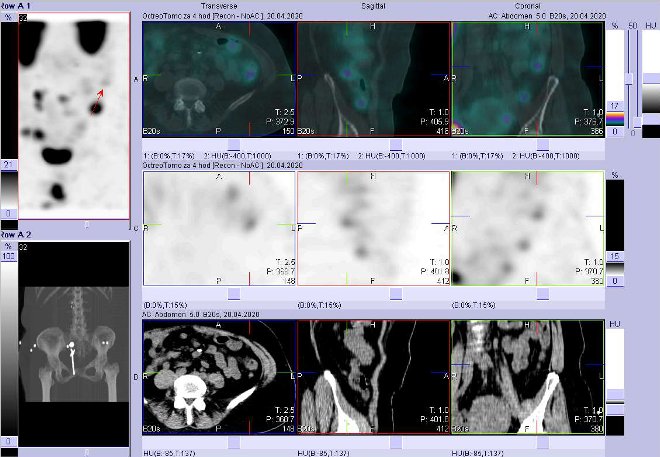 Obr. č. 5: Fúze SPECT/CT břicha a pánve 4 hod. po aplikaci OctreoScanu. Zaměřeno na ložisko v břiše vlevo nad pánví.