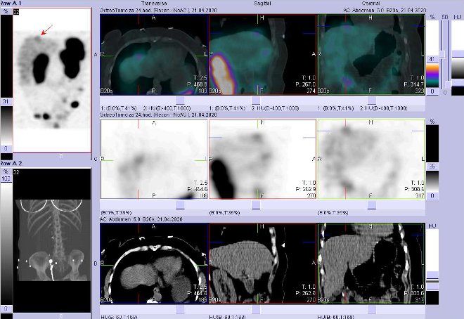 Obr. č. 7: Fúze SPECT/CT břicha a pánve 24 hod. po aplikaci OctreoScanu. Zaměřeno na suspektní ložisko v pravém laloku jaterním ventrokraniálně.