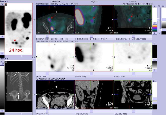 Obr. č. 8: Fúze SPECT/CT břicha a pánve 24 hod. po aplikaci OctreoScanu. Zaměřeno na ložisko v pánvi vpravo ventrálně.