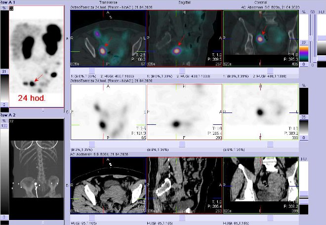 Obr. č. 9: Fúze SPECT/CT břicha a pánve 24 hod. po aplikaci OctreoScanu. Zaměřeno na ložisko v pánvi vpravo.