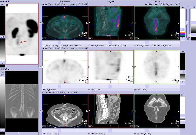 Obr. č. 1: Fúze SPECT/CT břicha a pánve 4 hod. po aplikaci OctreoScanu. Zaměřeno na ložisko v průběhu jizvy po laparotomii vpravo od střední čáry.