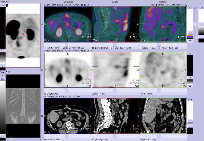 Obr. č. 2: Fúze SPECT/CT břicha a pánve 4 hod. po aplikaci OctreoScanu. Zaměřeno na ložisko v infiltrátu při uncinátním výběžku pankreatu.