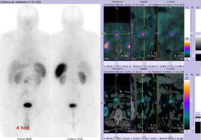 Obr. č. 4: Celotělová scintigrafie a fúze SPECT/CT břicha 4 hod. po aplikaci OctreoScanu. Zaměřeno na ložisko na radixu mezenteria v blízkosti mezenteriálního cévního svazku.