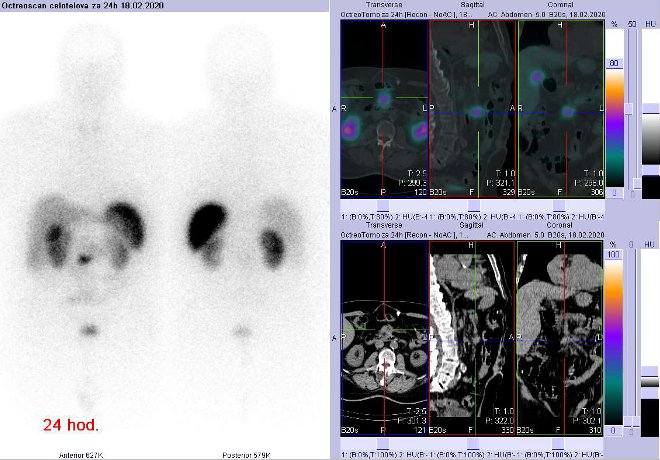 Obr. č. 7: Celotělová scintigrafie a fúze SPECT/CT břicha 24 hod. po aplikaci OctreoScanu. Zaměřeno na ložisko na radixu mezenteria v blízkosti mezenteriálního cévního svazku.