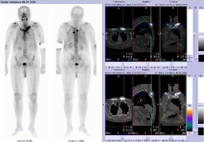 Obr.1: Celotělová scintigrafie v přední a zadní projekci a fúze obrazů SPECT/CT a samostatné CT.  Vpravo zaměřeno na ložisko v levé klíční kosti. Řezy transverzální,  sagitální a koronální.