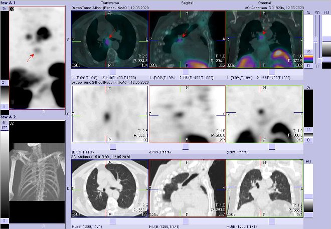 Obr. č. 10: Fúze SPECT/CT hrudníku 24 hod. po aplikaci OctreoScanu. Zaměřeno na ložisko v plíci  vpravo paratracheálně.