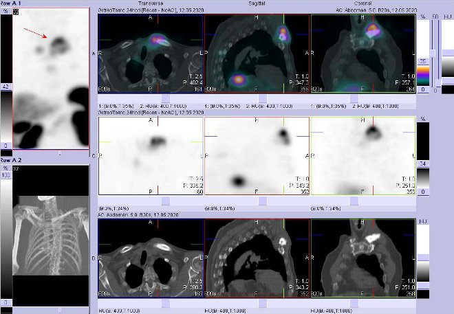 Obr. č. 13: Fúze SPECT/CT hrudníku 24 hod. po aplikaci OctreoScanu. Zaměřeno na ložisko v levé klíční kosti a jejím okolí.