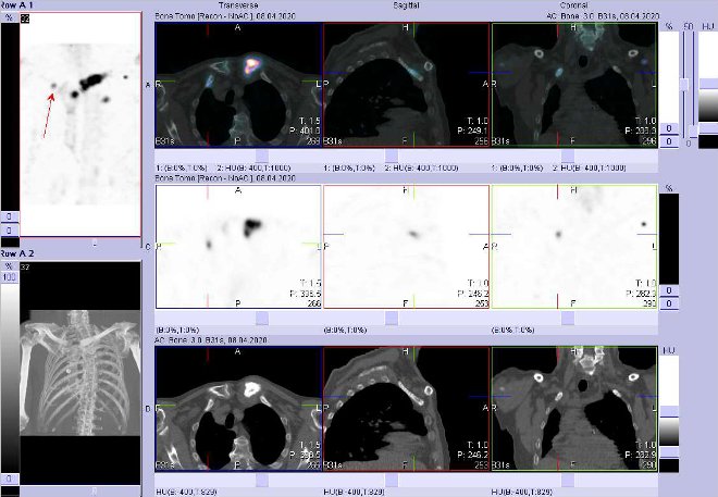 Obr.3: Fúze obrazů SPECT/CT.  Zaměřeno na ložisko ve ventrální části  1. žebra vpravo.