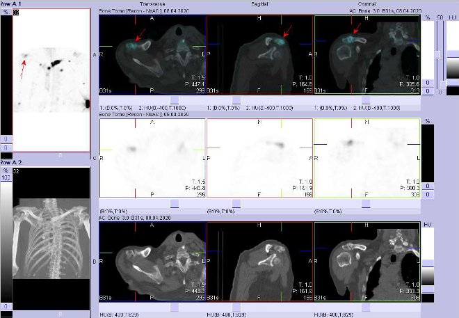 Obr. č. 5: Fúze obrazů SPECT/CT.  Zaměřeno na ložisko v acromion pravé lopatky.