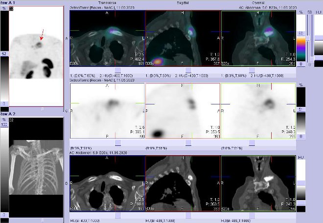 Obr. č. 8: Fúze SPECT/CT hrudníku 4 hod. po aplikaci OctreoScanu. Zaměřeno na ložisko v levé klíční kosti a jejím okolí.