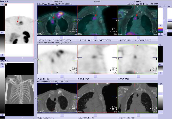 Obr. č. 9: Fúze SPECT/CT hrudníku 4 hod. po aplikaci OctreoScanu. Zaměřeno na ložisko ve ventrokraniální části pravé plíce.