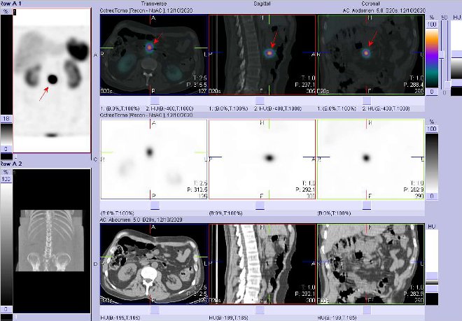 Obr.č.2: Fúze obrazů SPECT a CT – vyšetření břicha a pánve 4 hod. po aplikaci radiofarmaka. Zaměřeno na ložisko v břiše pod hlavou pankreatu v úrovni úseku D3 duodena velikosti 23x14 mm.