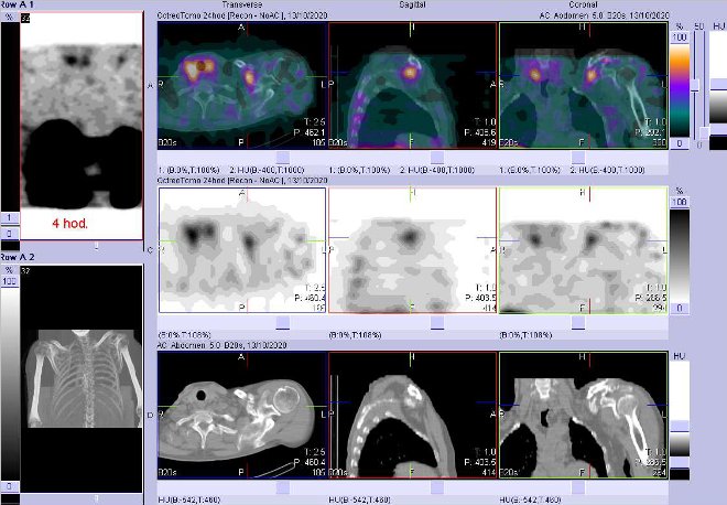Obr.3: Fúze obrazů SPECT a CT – vyšetření hrudníku 4 hod. po aplikaci radiofarmaka. Zaměřeno na laterální část levé klíční kosti.